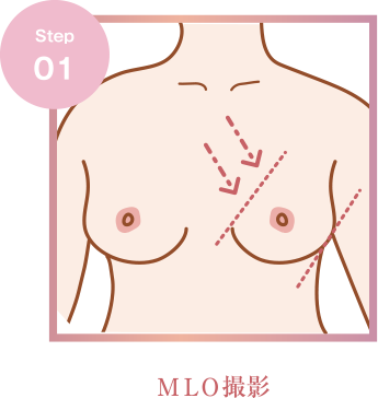 MLO撮影